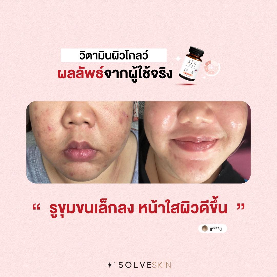 อยากรูขุมขนเล็กลง หน้าใสผิวดีขึ้น เหมือนสาวๆ SOLVESKIN ต้องมีตัวช่วย!