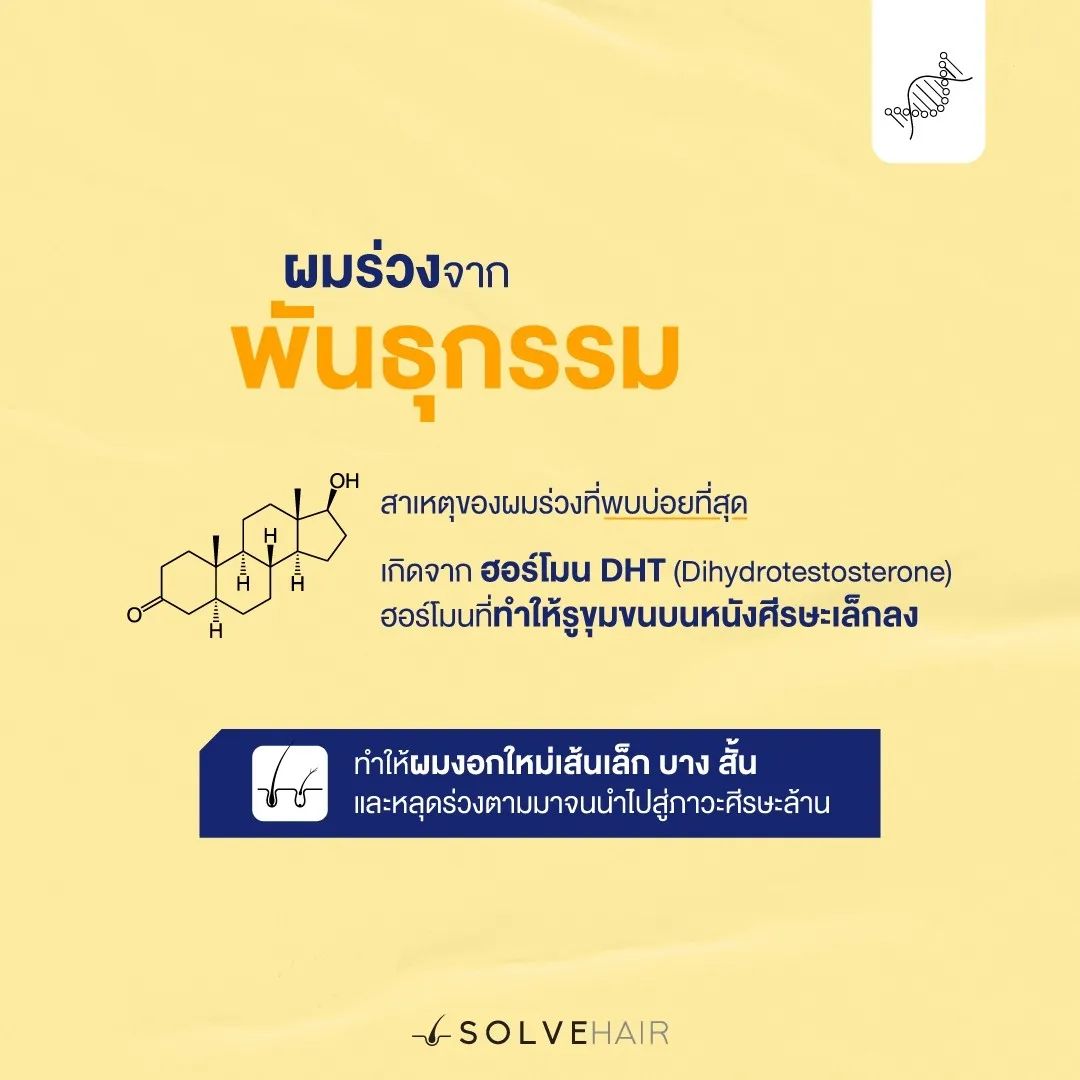 ผมร่วงพันธุกรรม