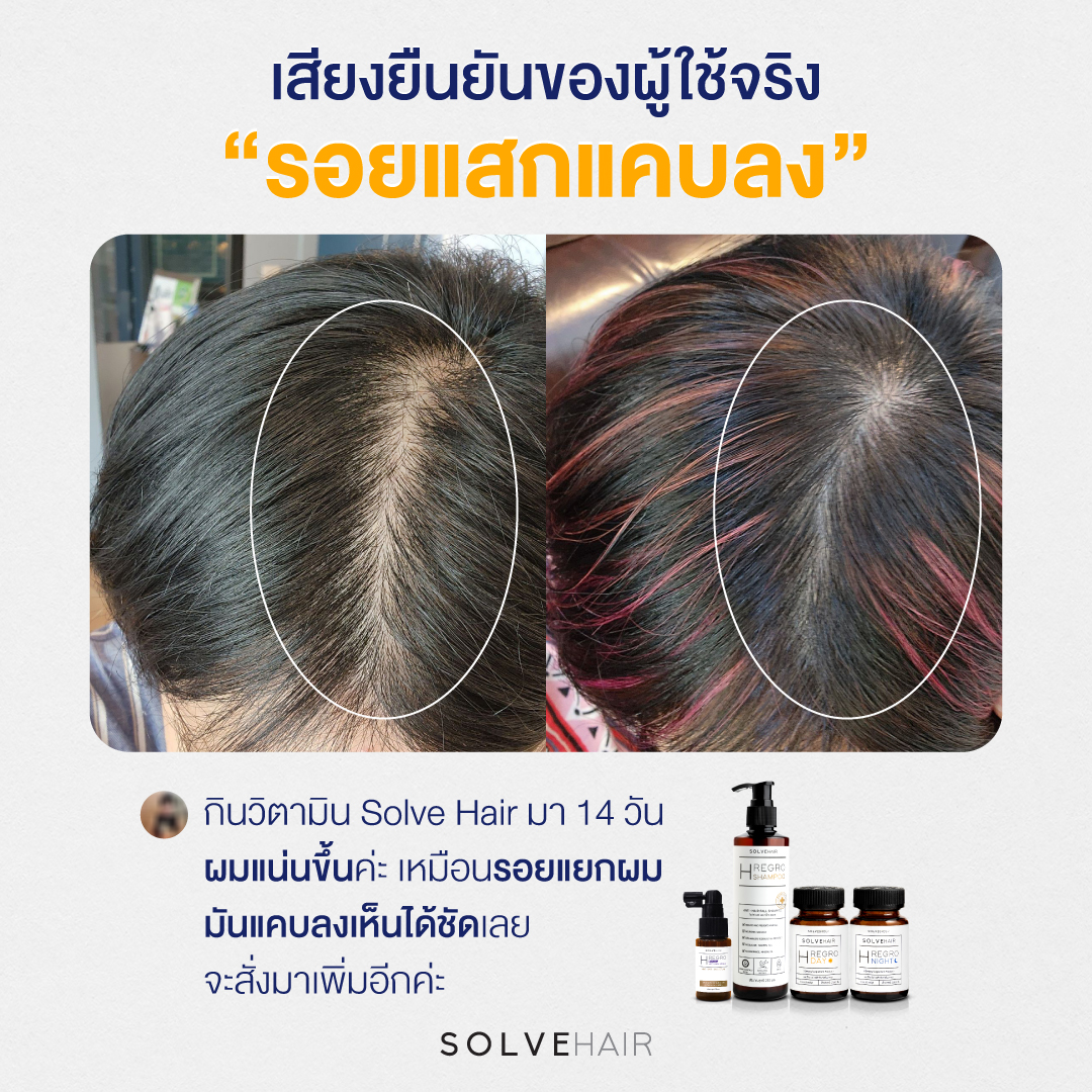 • กินวิตามิน Solve Hair มา 14 วัน ผมแน่นขึ้นค่ะ เหมือนรอยแยกผมมันแคบลงเห็นได้ชัดเลย จะสั่งมาเพิ่มอีกค่ะ