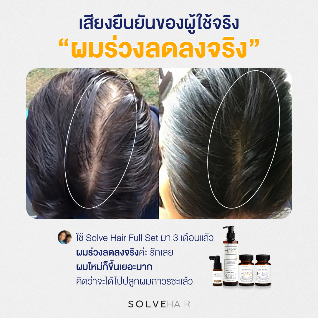 • ใช้ Solve Hair Full Set มา 3 เดือนแล้ว ผมร่วงลดลงจริงค่ะ รักเลย ผมใหม่ก็ขึ้นเยอะมาก คิดว่าจะได้ไปปลูกผมถาวรซะแล้ว