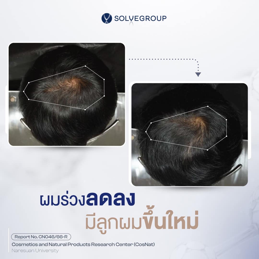 SolveHair ผมเปลี่ยน ใน 3 เดือน