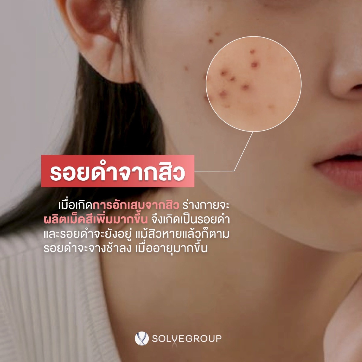 ปัจจัยที่ทำให้รอยสิว เข้มขึ้น และ หายช้าลง ปัจจัยที่ทำให้รอยสิว เข้มขึ้น และ หายช้าลง