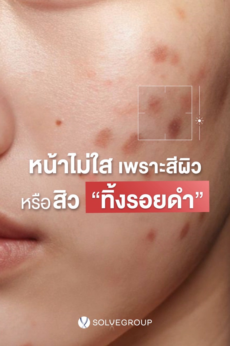 หน้าไม่ใส เพราะสีผิว หรือสิว ทิ้งรอยดำ หน้าไม่ใส เพราะสีผิว หรือสิว ทิ้งรอยดำ