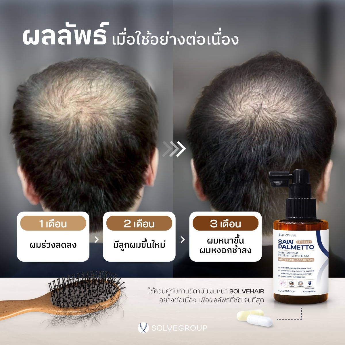 1 เดือน ผมร่วงลดลง  2 เดือน มีลูกผมขึ้นใหม่  3 เดือน ผมหนาขึ้น ผมหงอกช้าลง