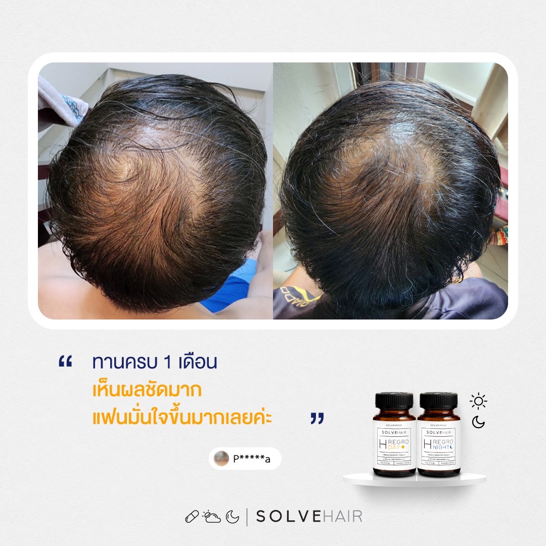 วิตามินผม SolveHair Day & Night ดูแลครบวงจรผม