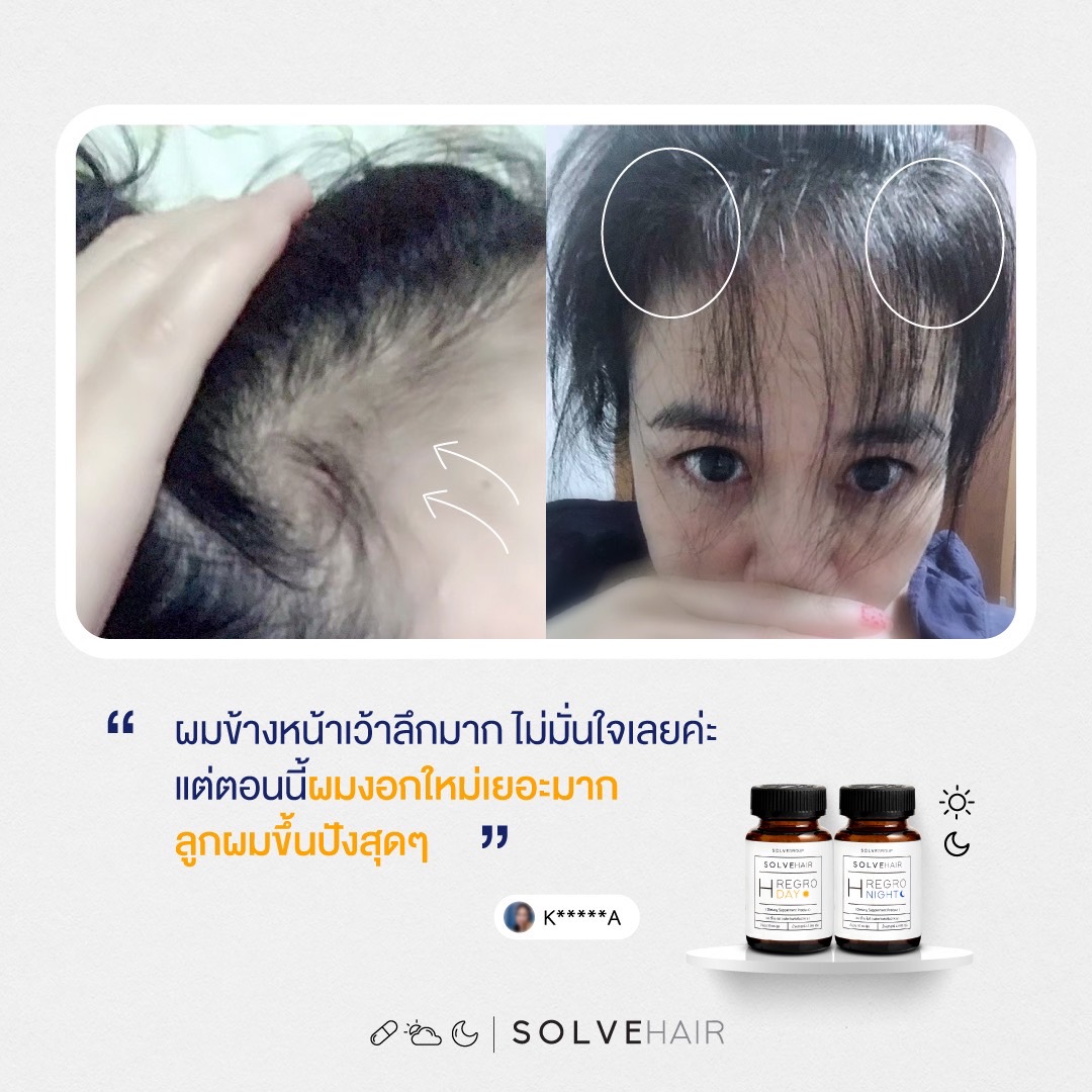 วิตามินผม SolveHair Day & Night ดูแลครบวงจรผม