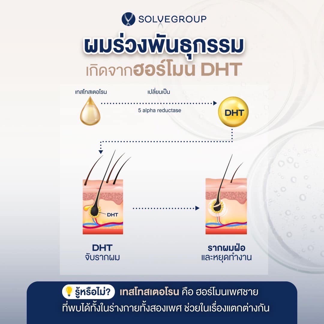 ผมร่วงพันธุกรรม เกิดจาก ฮอร์โมน DHT