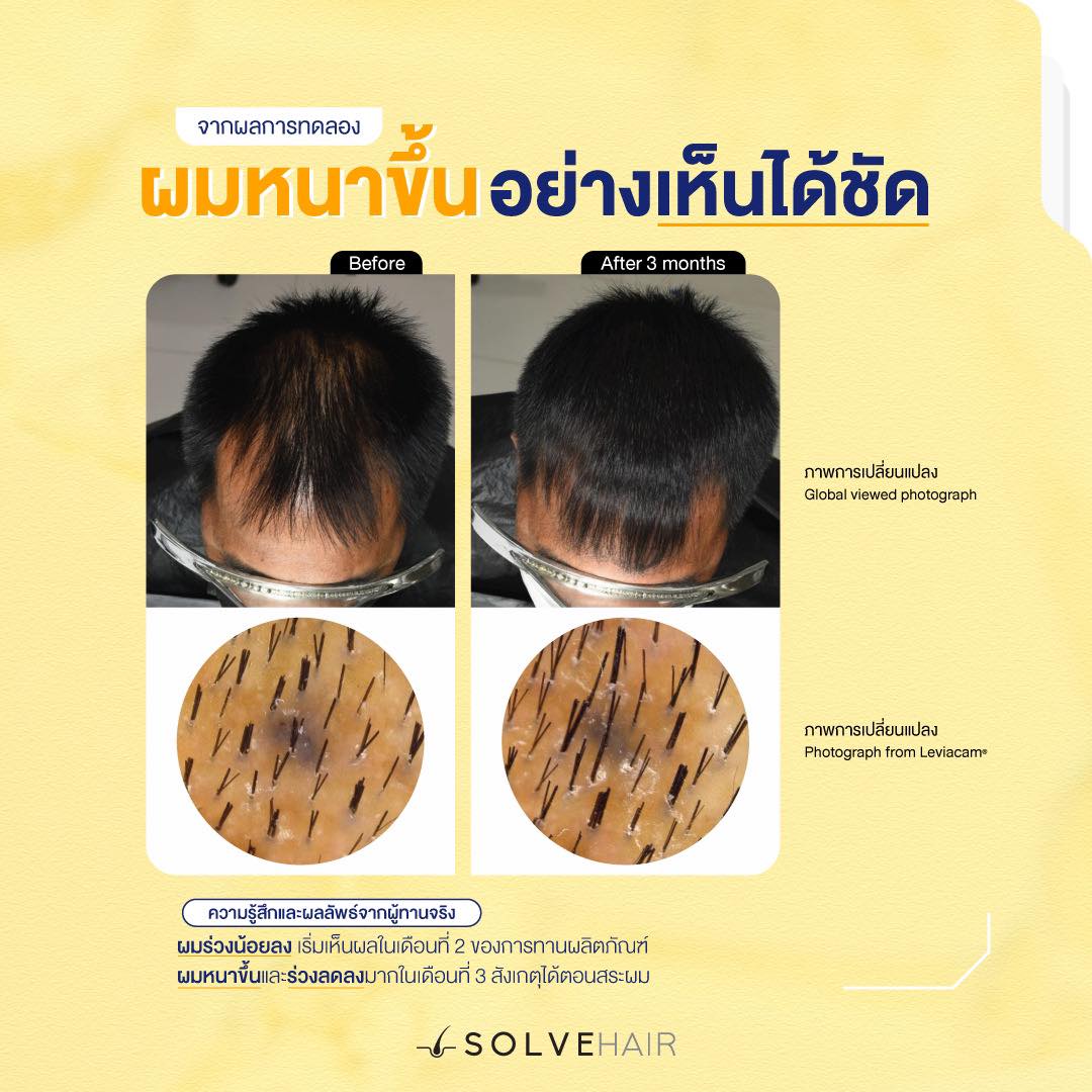 ความรู้สึกและผลลัพธ์จากผู้ทานจริง SolveHair