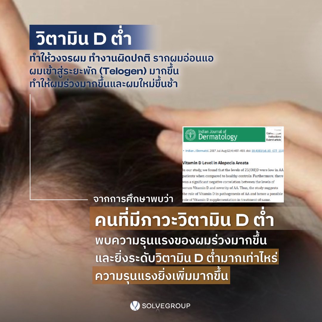 ผมร่วง…อาจไม่ใช่เพราะผมอ่อนแอแต่อาจเป็นเพราะ วิตามิน D3 ไม่พอ!