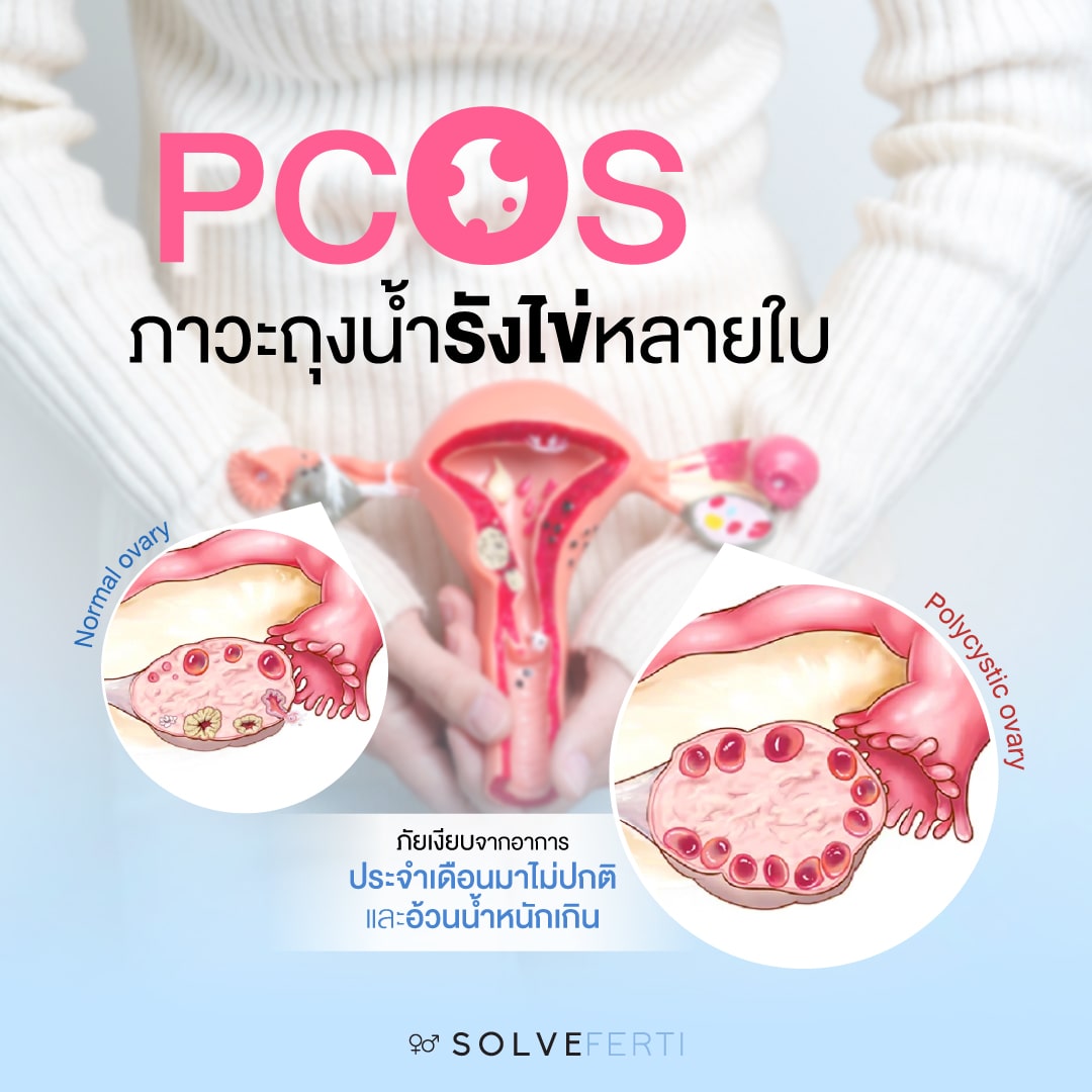 PCOS ภาวะถุงน้ำรังไข่หลายใบ