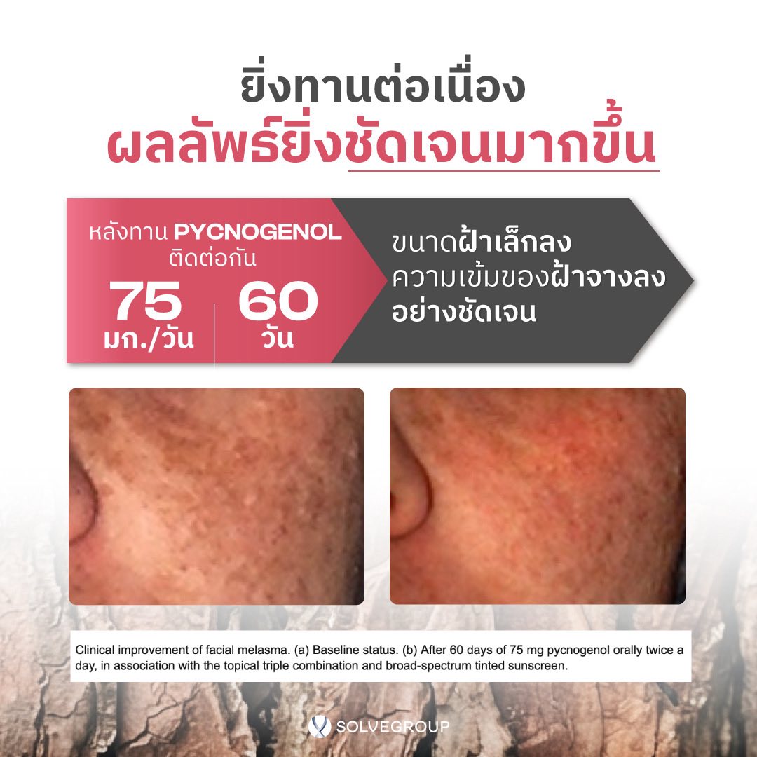PYCNOGENOL ขนาดฝ้าเล็กลง ติดต่อกัน