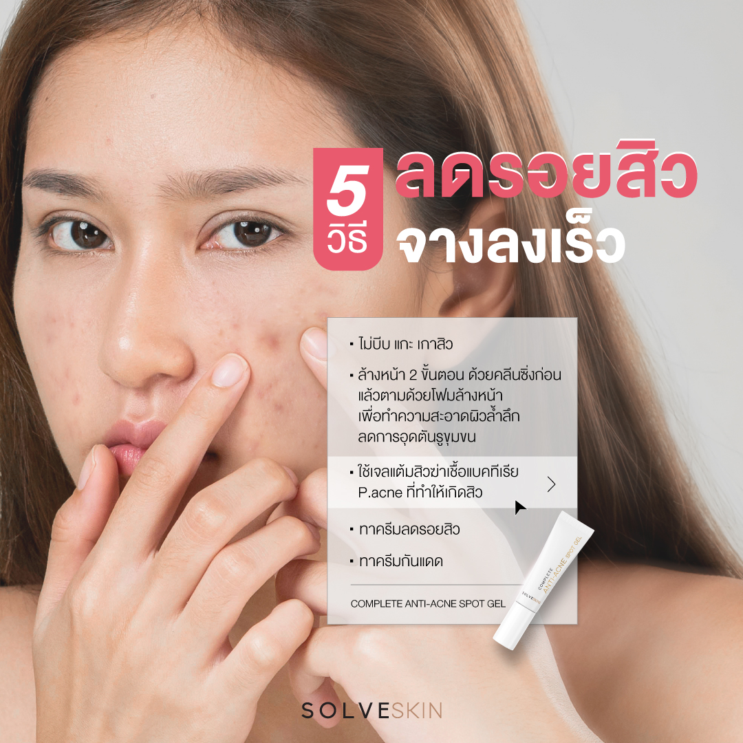 5 วิธี ลดรอยสิว จางลงเร็ว