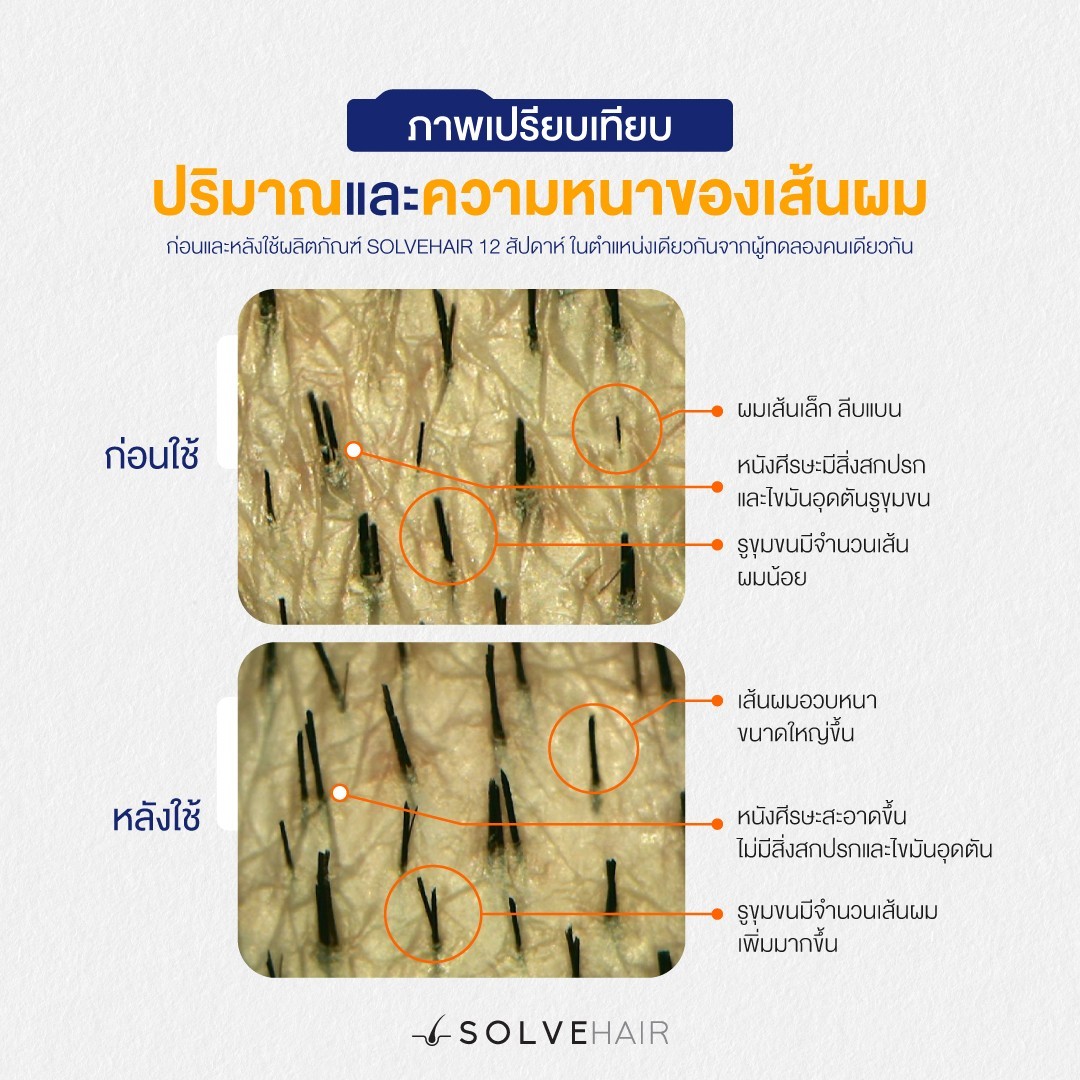 ภาพเปรียบเทียบ ปริมาณและความหนาของเส้นผม ก่อนและหลังใช้ผลิตภัณฑ์ SOLVEHAIR 12 สัปดาห์ ในตำแหน่งเดียวกันจากผู้ทดลองคนเดียวกัน