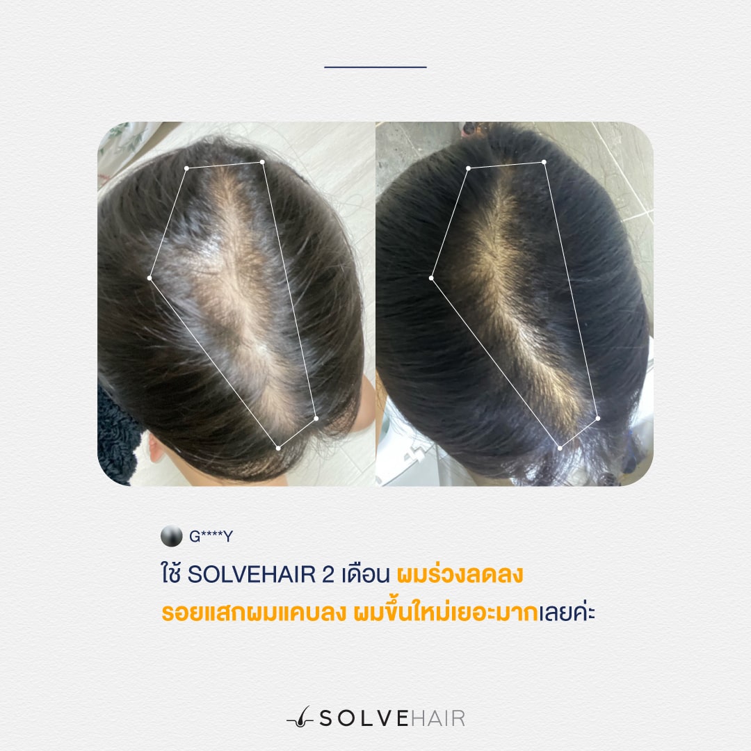 ใช้ SOLVEHAIR 2 เดือน ผมร่วงลดลง รอยแสกผมแคบลง ผมขึ้นใหม่เยอะมากเลยค่ะ