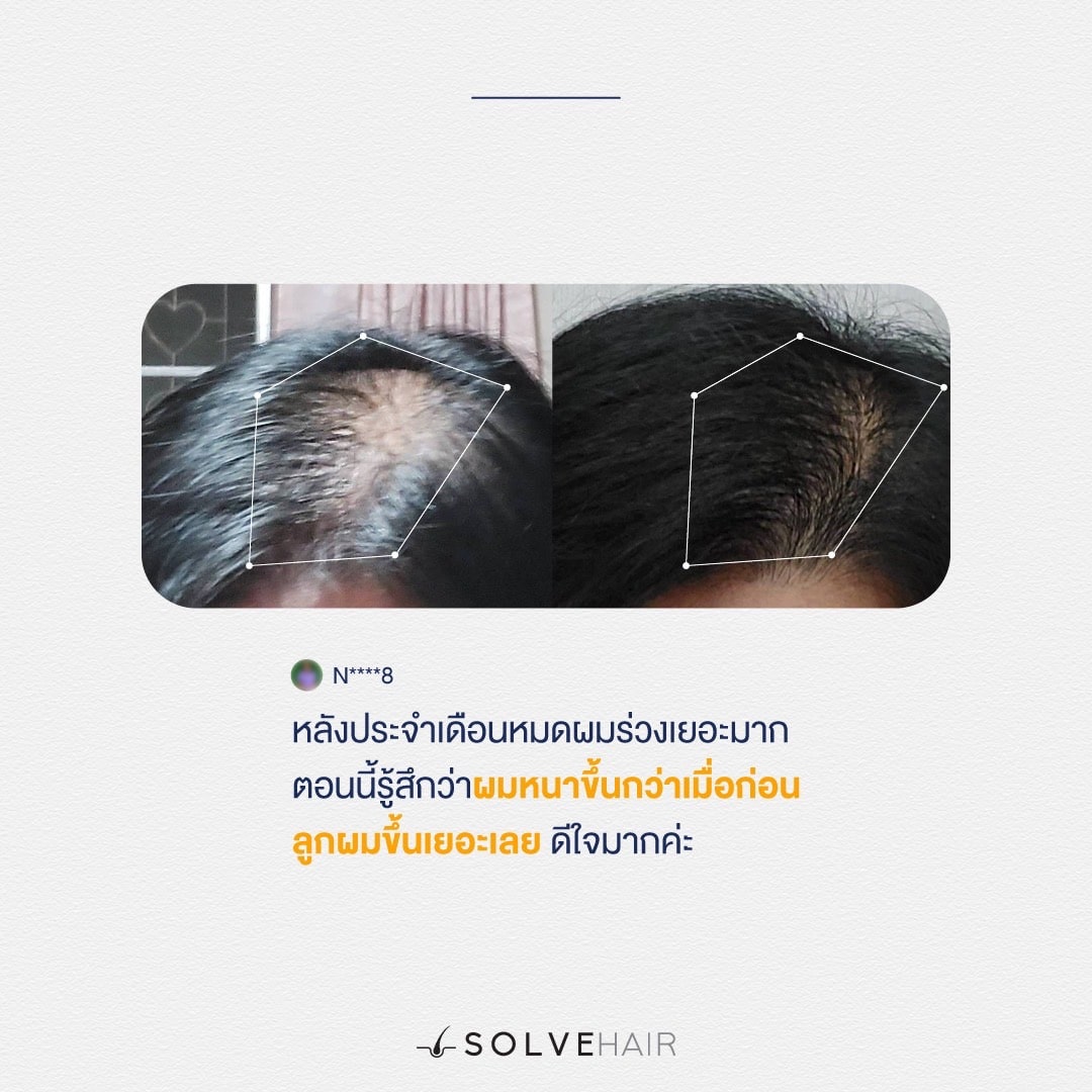 ปกติผมตรงกลางไม่เคยยาวเลย ลองมาหลายอย่างแล้วก็ไม่ดีขึ้น แต่ใช้ SOLVEHAIR แค่ 3 สัปดาห์ ผมขึ้นมาเยอะมาก ร้านตัดผมยังทัก