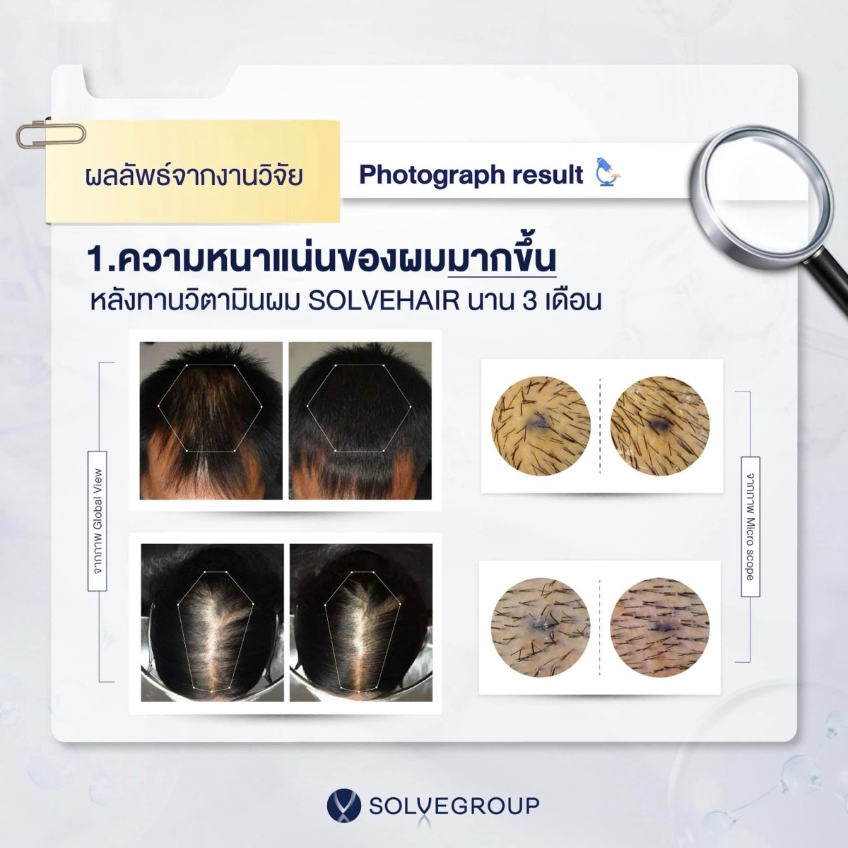 ผลลัพธ์จากงานวิจัยจากมหาวิยาลัยนเรศวร • จากภาพถ่าย Global view ชี้ให้เห็นว่า • ความหนาแน่นของผมมากขึ้น”หลังจากทานวิตามินผม SOLVEHAIR นาน 3 เดือน