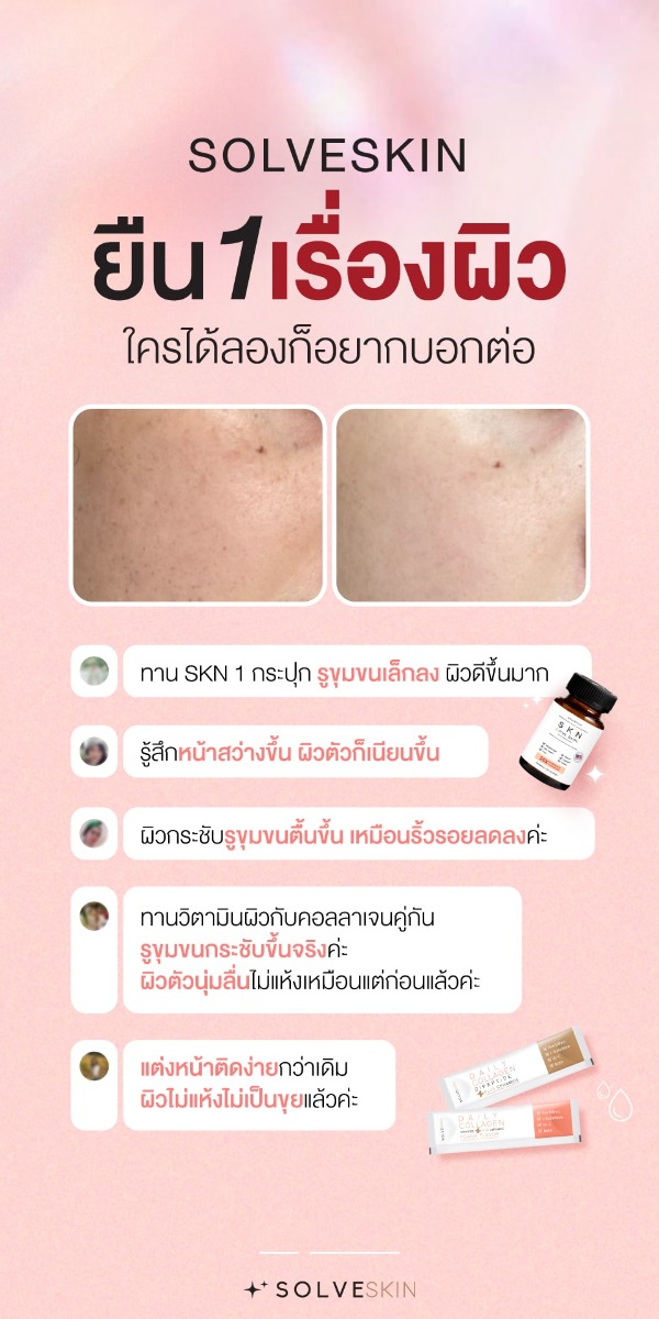 ยืน 1 เรื่องผิวต้อง SOLVESKIN โดยผู้เชี่ยวชาญด้านผิวหนัง