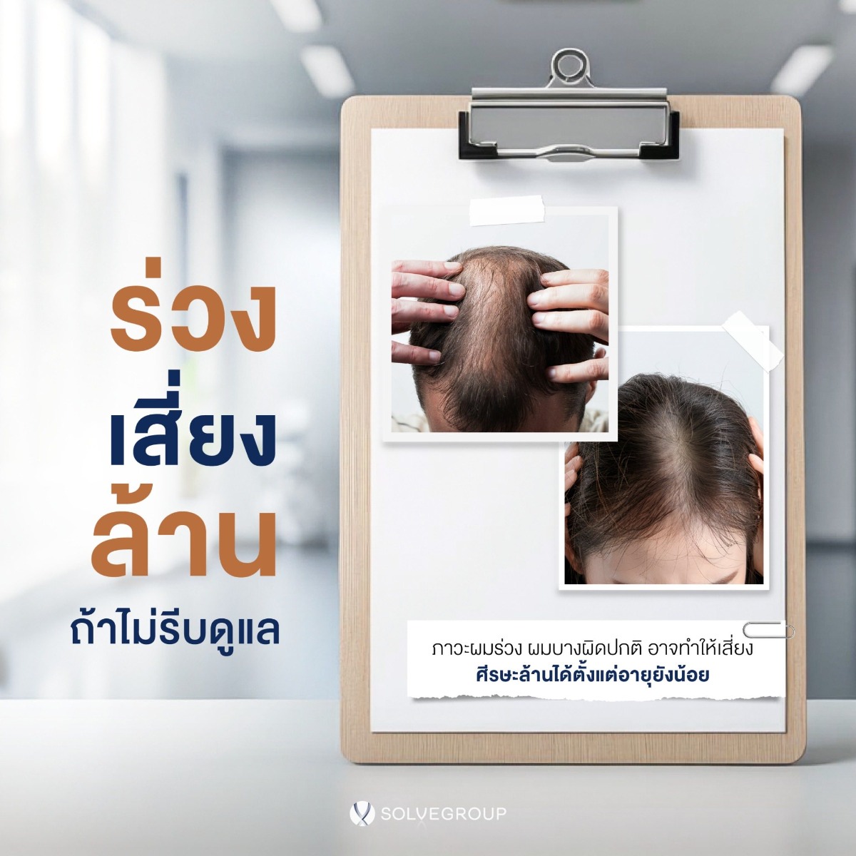 ผมร่วง เสี่ยง ผมล้าน ถ้าไม่รีบดูแล ภาวะผมร่วง ผมบางผิดปกติ อาจทำให้เสี่ยง ศีรษะล้านได้ตั้งแต่อายุยังน้อย