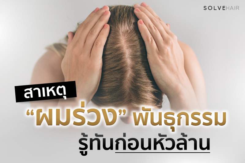 สาเหตุผมร่วงพันธุกรรม รู้ทันก่อนหัวล้าน