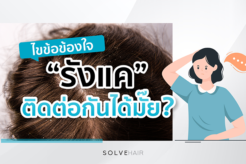 ไขข้อข้องใจ รังแค ติดต่อกันได้มั้ย? 