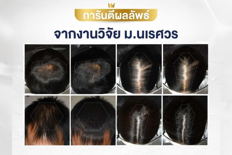 SolveHair การันตีผลลัพธ์ จากงานวิจัย ม.นเรศวร