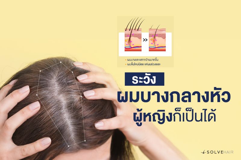 ระวัง ผมบางกลางหัว ผู้หญิงก็เป็นได้