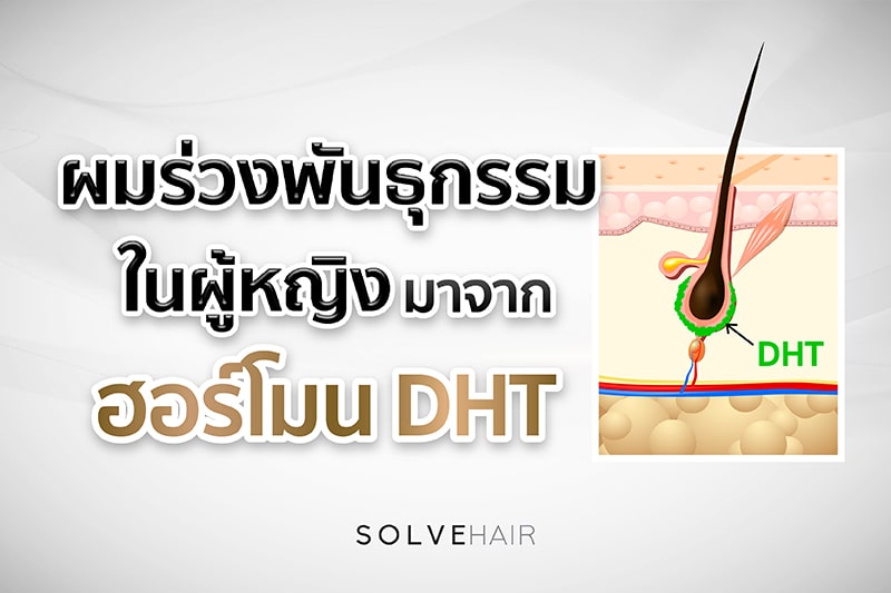 ผมร่วงพันธุกรรมในผู้หญิง มากจาก ฮอร์โมนDHT