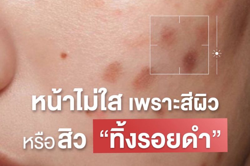 หน้าไม่ใส เพราะสีผิว หรือสิว ทิ้งรอยดำ