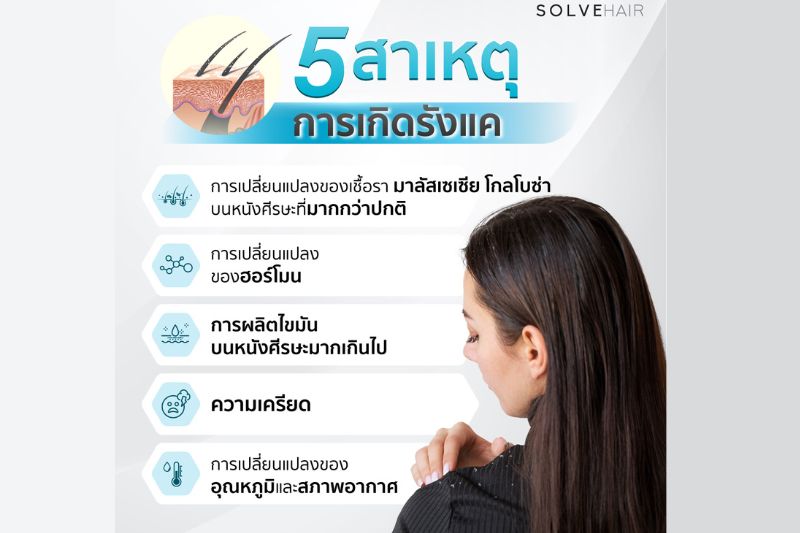 5 สาเหตุ การเกิดรังแค บนหนังศีรษะ 