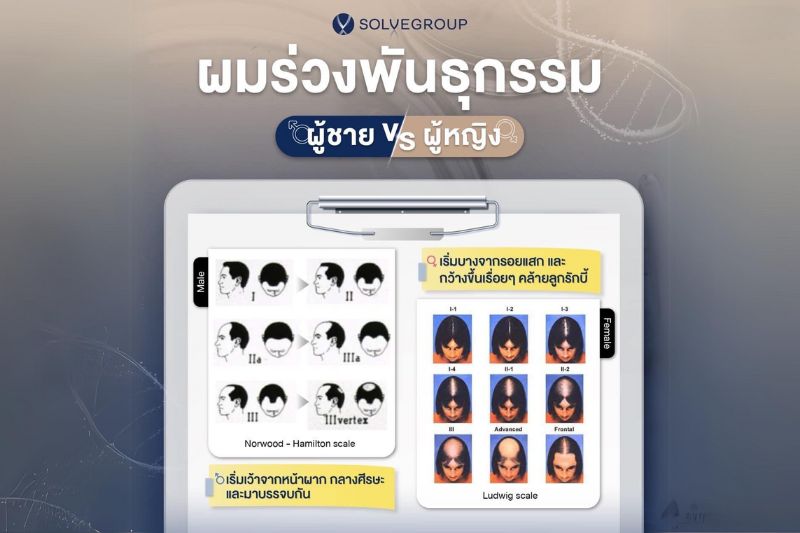 ผมร่วงพันธุกรรม ผู้ชาย VS ผู้หญิง