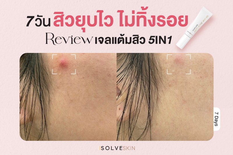 Review เจลแต้มสิว 7วัน สิวยุบไว ไม่ทิ้งรอย