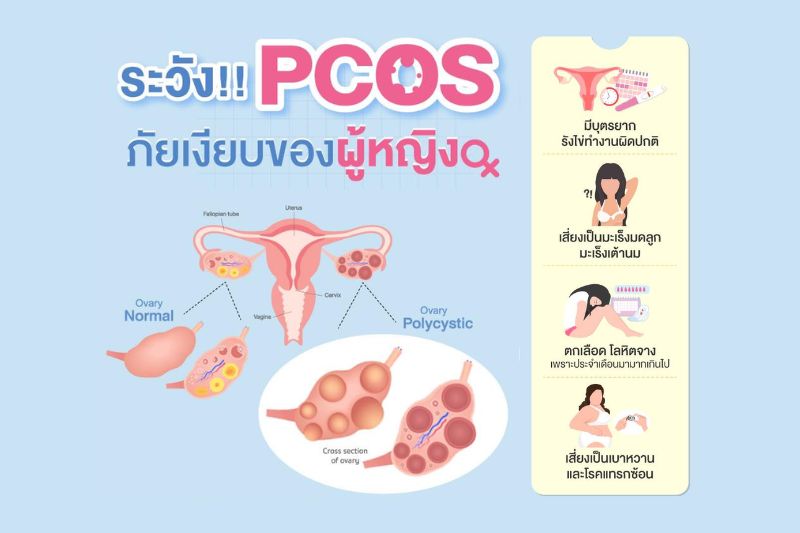 ระวัง PCOS ภัยเงียบของผู้หญิง