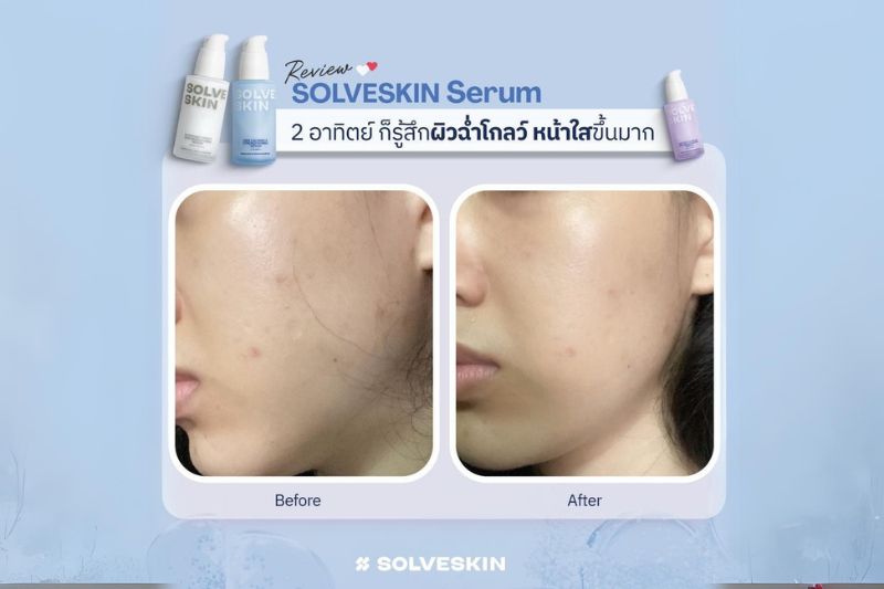 Review SolveGroup Serum 2 อาทิตย์ รู้สึกผิวฉ่ำโกลว์ หน้าใส